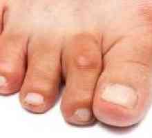 Artritida prstů a nohou, příznaky a léčba