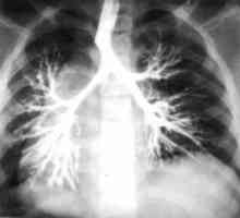 Bronchiektázie (bronchiektázie): Příčiny, příznaky a léčba