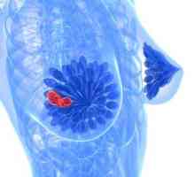 Fibrocystické onemocnění prsů: symptomy