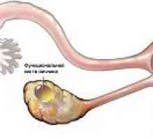 Funkční ovariální cysty - příznaky, léčba