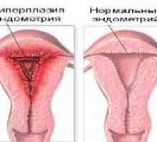 Hyperplazie endometria léčba menopauza