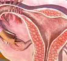 Chronická endometria rakovina - příčiny, příznaky, léčba