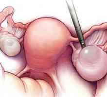 Endometria ovariální cysty