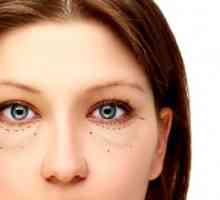 Váčky pod očima: příčiny a léčba