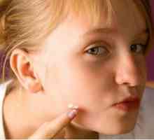 Proč se a jak odstranit akné na tvářích