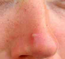Pupínky na nose: příčinách, léčbu a prevenci