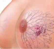 Rakovina prsu: příčiny, příznaky, léčba