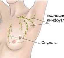 Příznaky rakoviny prsu