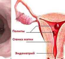 Odstranění polypů endometria: jak zacházet