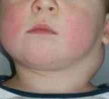 Zvětšené lymfatické uzliny na krku dítěte. Příčiny a léčba.