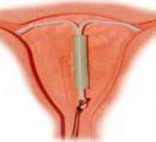 IUD jako formu antikoncepce