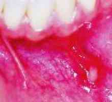 Zánět ústní dutiny: příčiny, léčba