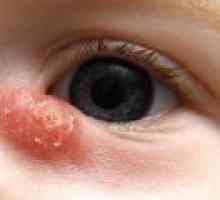Nemoci slzného ústrojí u dětí