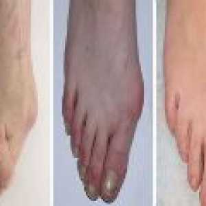 Artróza nohy: příčiny, příznaky, léčba
