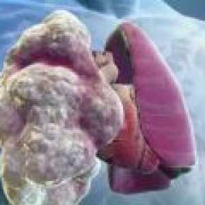 Rozedma plic - příznaky, léčba