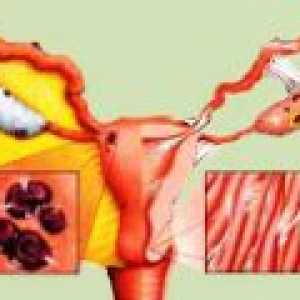 Endometrióza: symptomy, příznaky, léčba