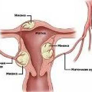 Děložní myomy v průběhu těhotenství, příčiny, léčba