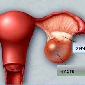 Nejedná se o velmi příjemné s diagnózou - ovariální folikulární cysty