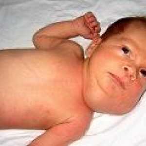Vrozená lymfangiom dítěte: příznaky a léčba