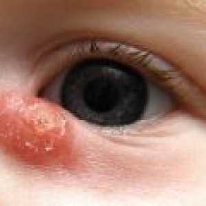 Nemoci slzného ústrojí u dětí