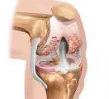Artróza kolenního stupně 3: Léčba