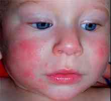 Diatéza u novorozenců na obličeji: Léčba