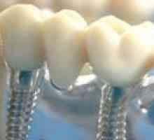 Zubní implantáty: základní fakta