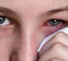 Zánět oční spojivky - příčiny, příznaky a léčba