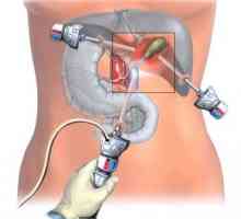 Laparoskopie žlučníku: operace projde
