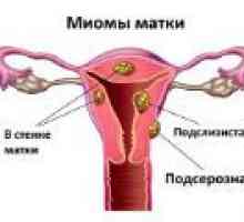 Více děložní myomy - příčiny, příznaky, léčba