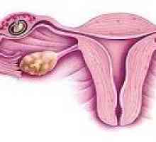 Persistence ovariální folikul - příčiny, příznaky, léčba