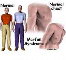 Marfanův syndrom