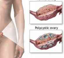 Syndrom polycystických ovarií