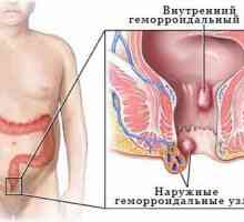Vnitřní hemoroidy - příznaky