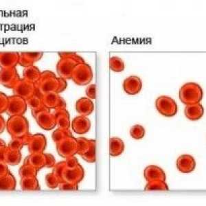 Anémie krve, což má za následek chudokrevnost, krve?