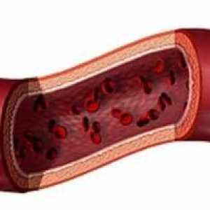 Hemoragické vaskulitida - příčiny, příznaky, diagnostika a léčba