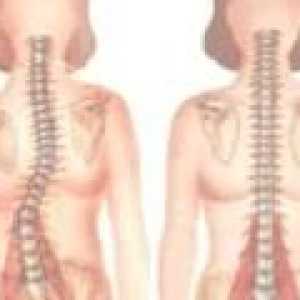 Kýly spinální SHmorlja: příznaky, léčba