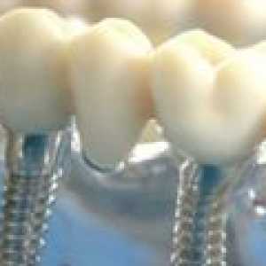 Zubní implantáty: základní fakta