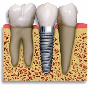 Zubní implantáty: kontraindikace a možné komplikace