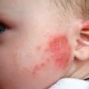 Červené skvrny na kůži dítěte - příčiny, léčba