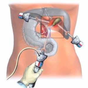 Laparoskopie žlučníku: operace projde