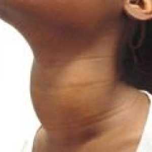 Příznaky hypotyreózy u žen