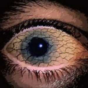 Syndrom suchého oka