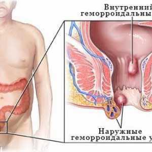 Vnitřní hemoroidy - příznaky